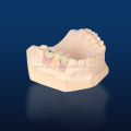 3D Printed Implant Restoration Model